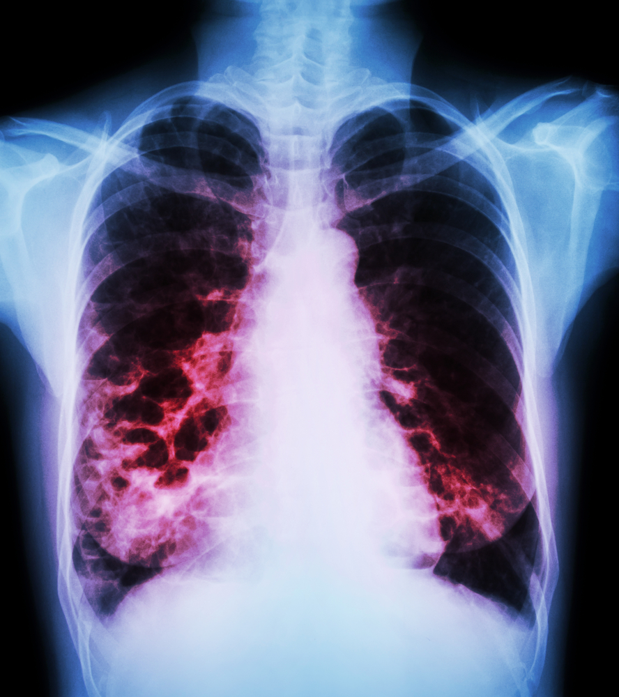 Study Identifies Clinical Characteristics of Chronic Obstructive Pulmonary Disease with Bronchiectasis
