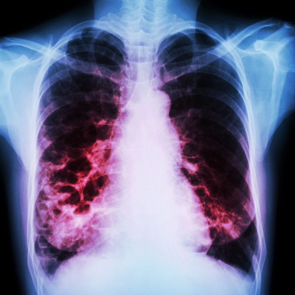 Pseudomonas aeruginosa responsible for bronchiectasis exacerbations in ...