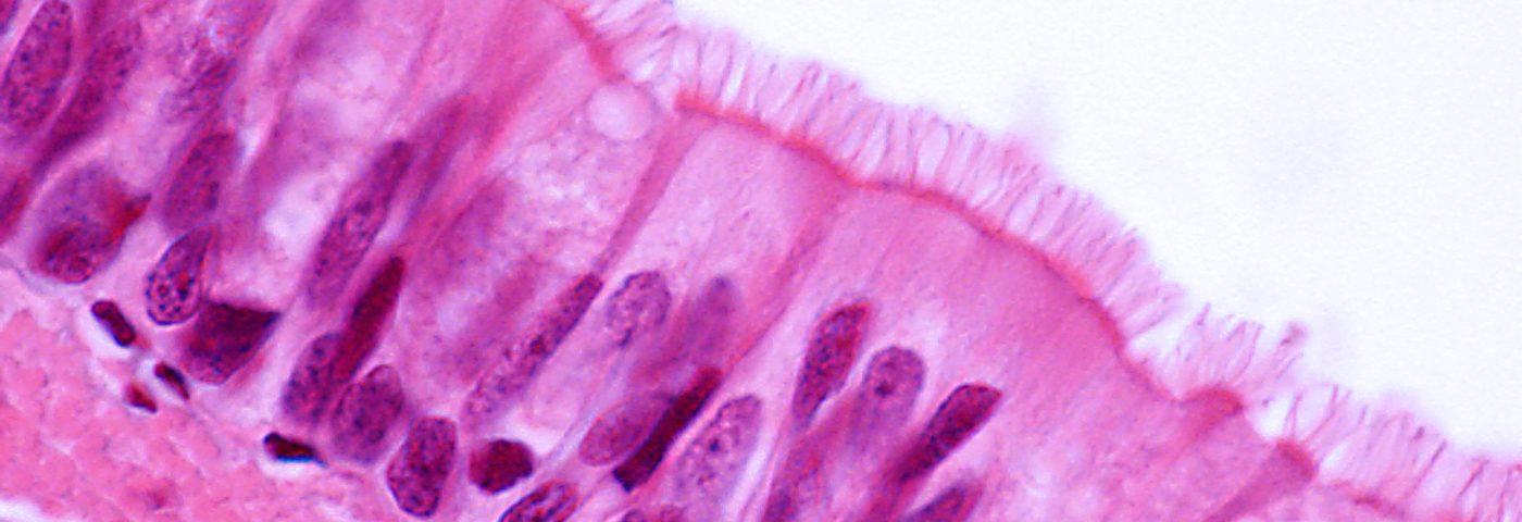 Small Study Finds Bronchiectasis Caused by Kartagener Syndrome in Some Patients