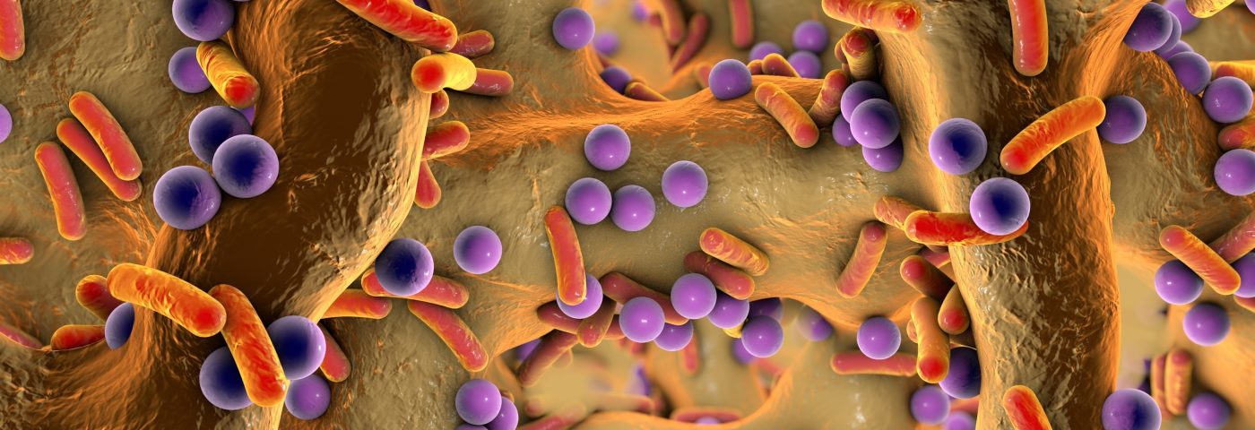 Bacteria in Bronchiectasis Airways Should Be Closely Monitored, Study Reports