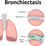 bronchiectasis Smartvest
