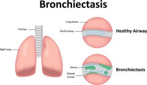 what is Bronchiectasis?
