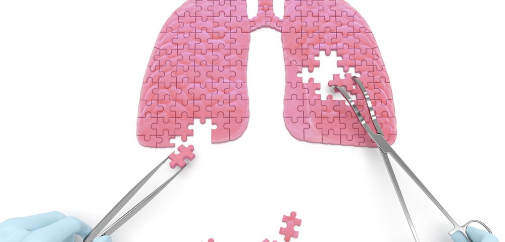 Surgery May Be Wise Choice for Select Patients With Diffuse Bronchiectasis, Study Finds