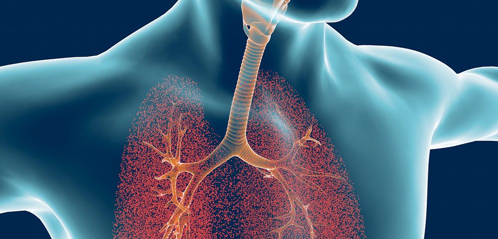 Bronchiectasis Worsens Lung Function, Quality of Life in Severe Asthma, Study Finds
