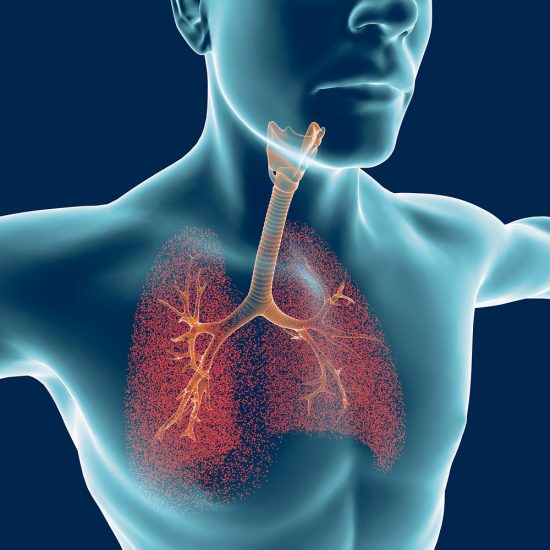 Bronchiectasis Symptoms and Signs - Bronchiectasis News Today