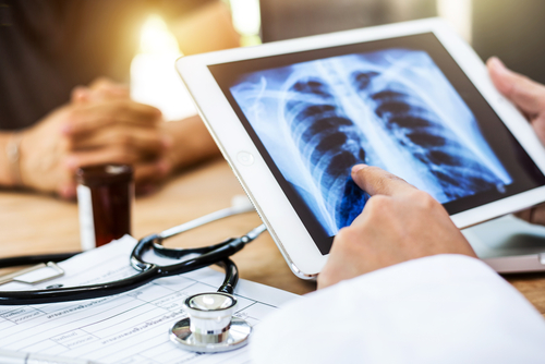 Bronchiectasis More Common in COPD Patients with Emphysema, Study Reports