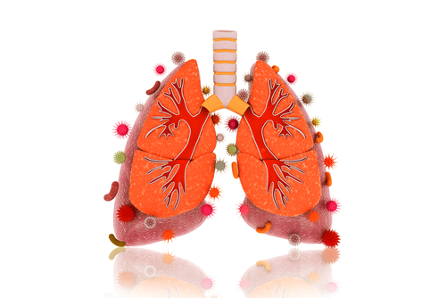 Analysis Links Pneumonia With Bronchiectasis to Less Mortality, More Infections